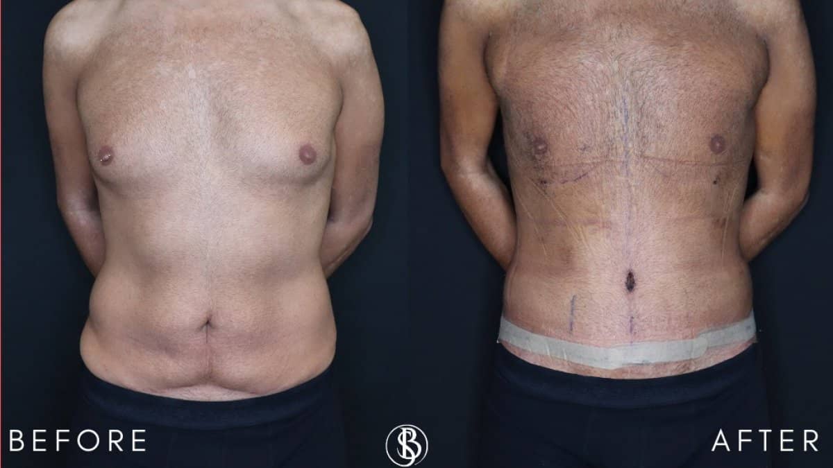 Case 12467 - abdominal etching