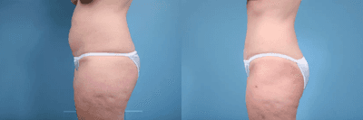 Case 1247 - Woman treated with Tummy Tuck