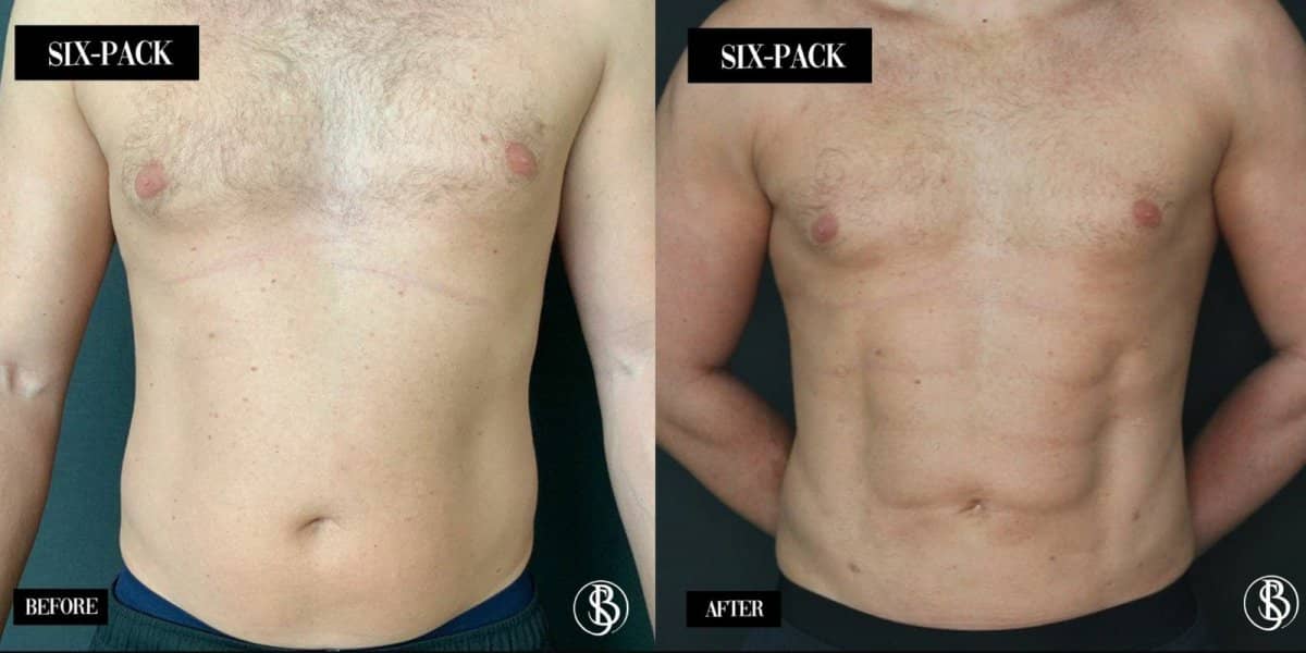 Case 12471 - Brazilian Butt Lift