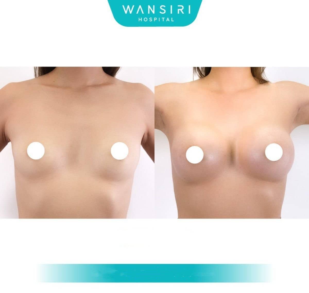 Case 12473 - breast augmentation