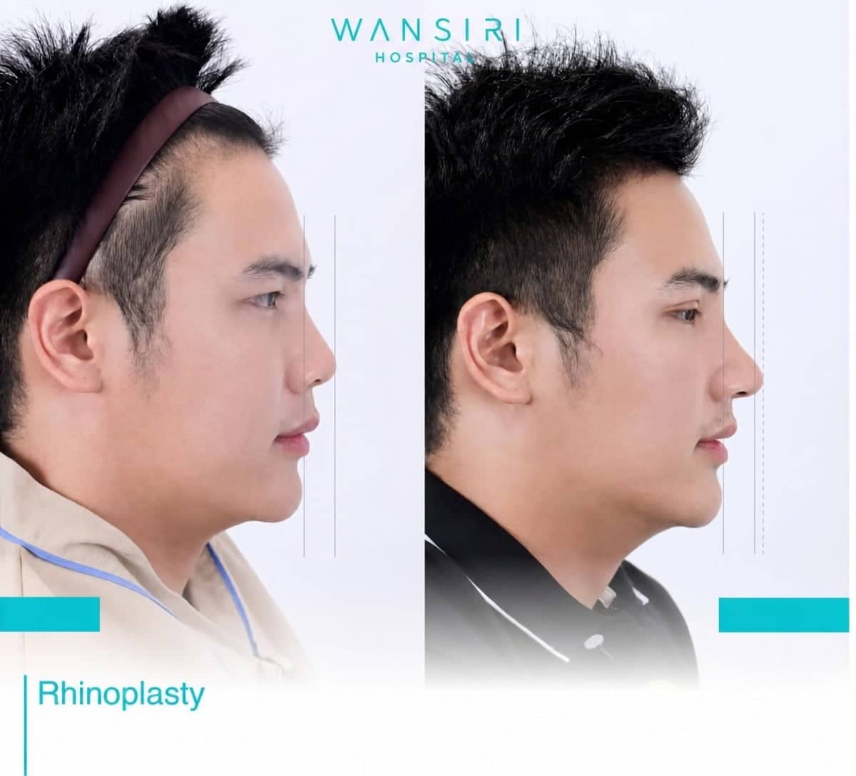 Case 12474 - closed rhinoplasty