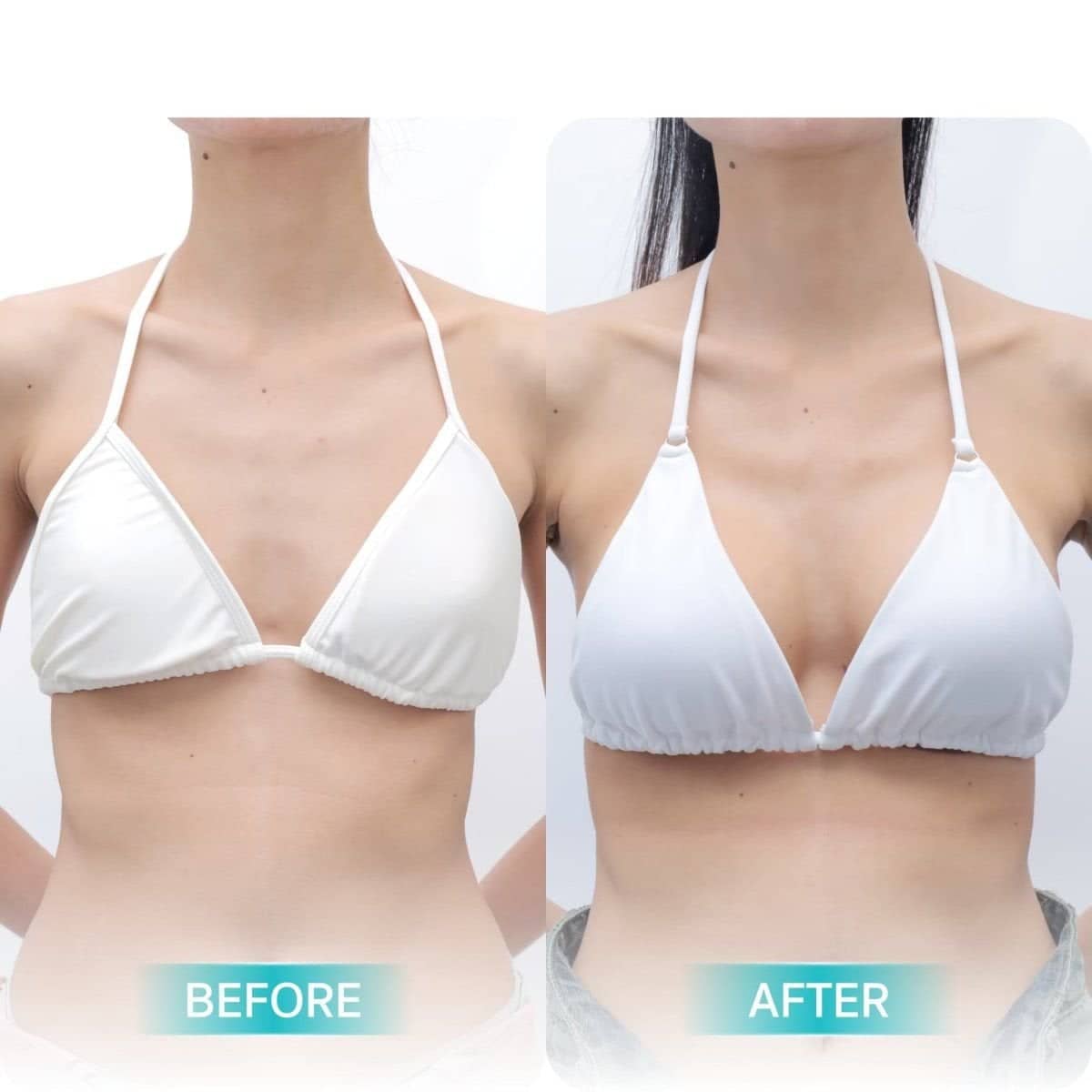Case 12475 - breast augmentation