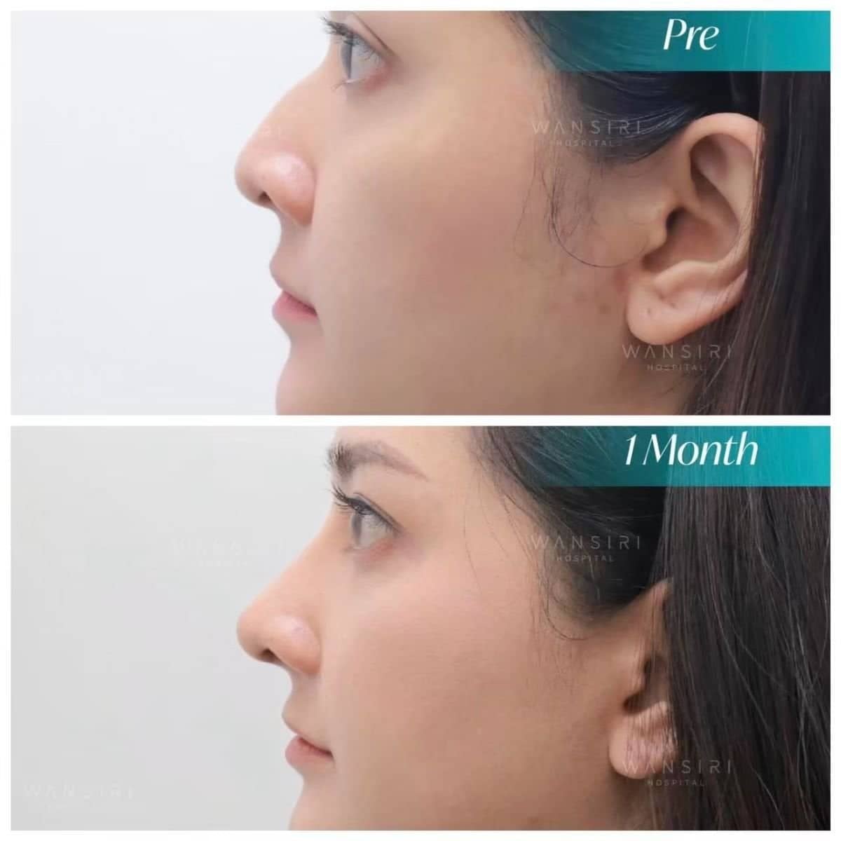 Case 12478 - tip rhinoplasty