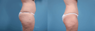 Case 1248 - Woman treated with Tummy Tuck