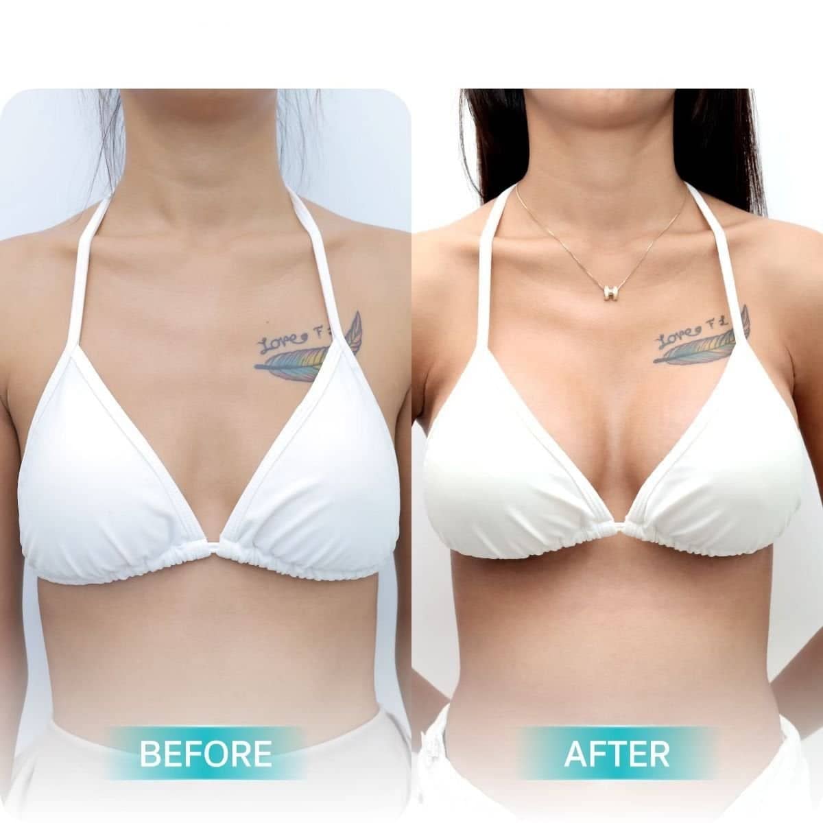 Case 12481 - breast augmentation