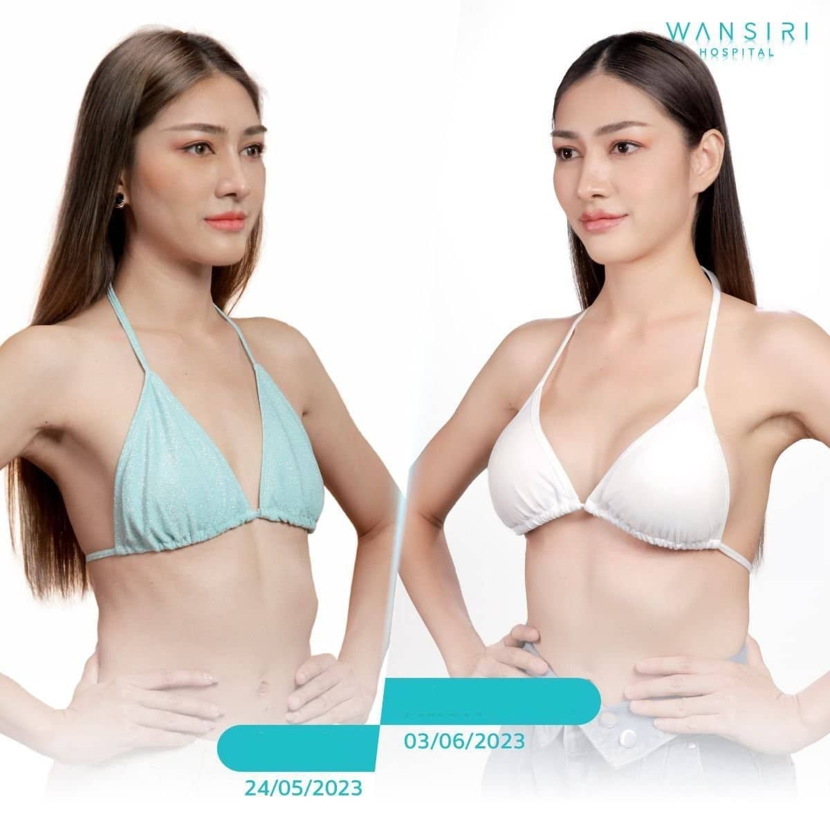 Case 12482 - breast augmentation