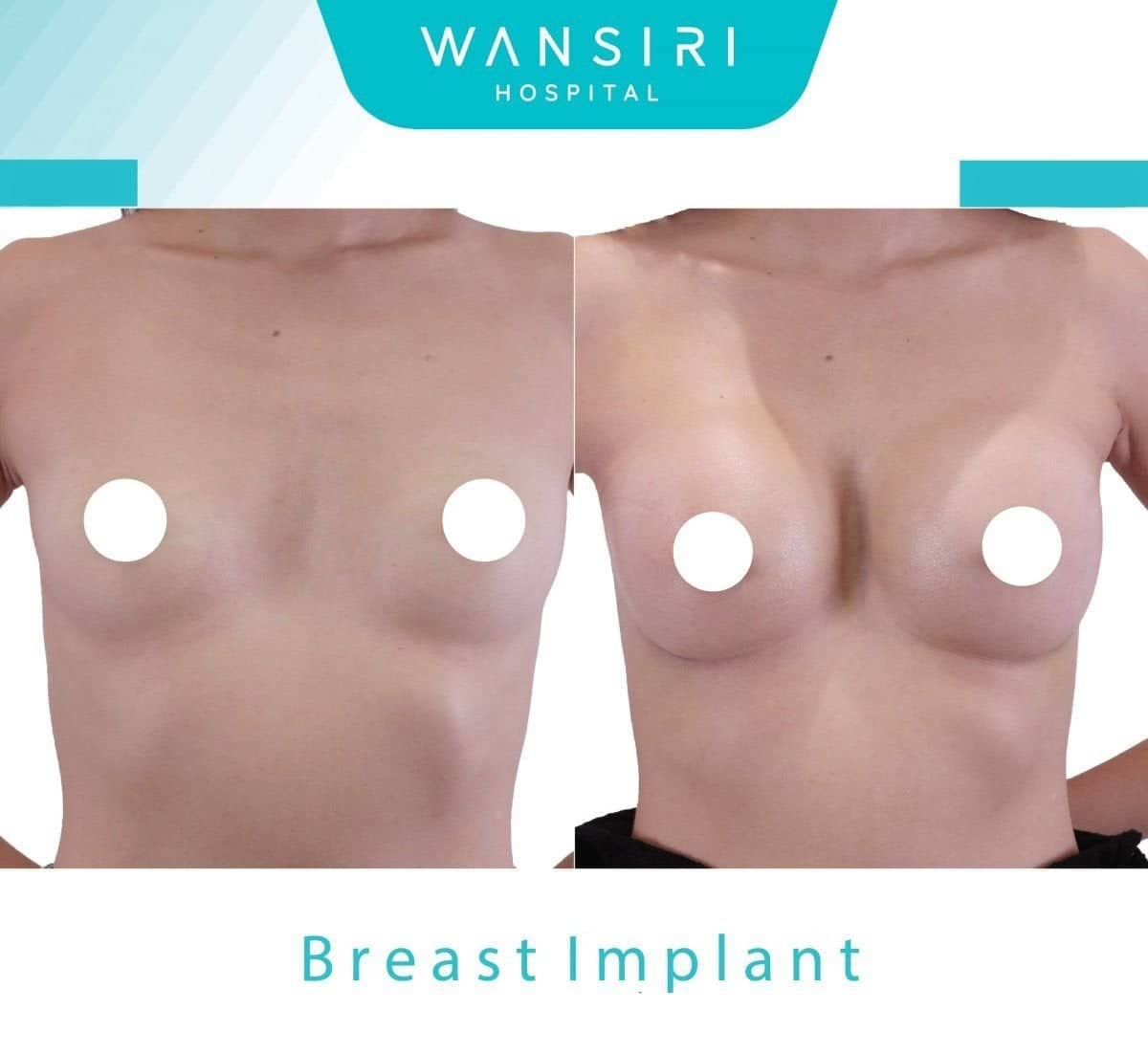 Case 12485 - breast augmentation