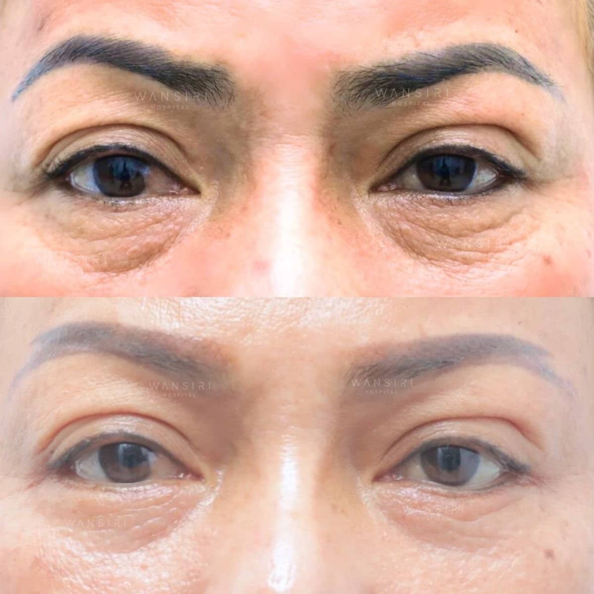 Case 12486 - lower eyelid blepharoplasty