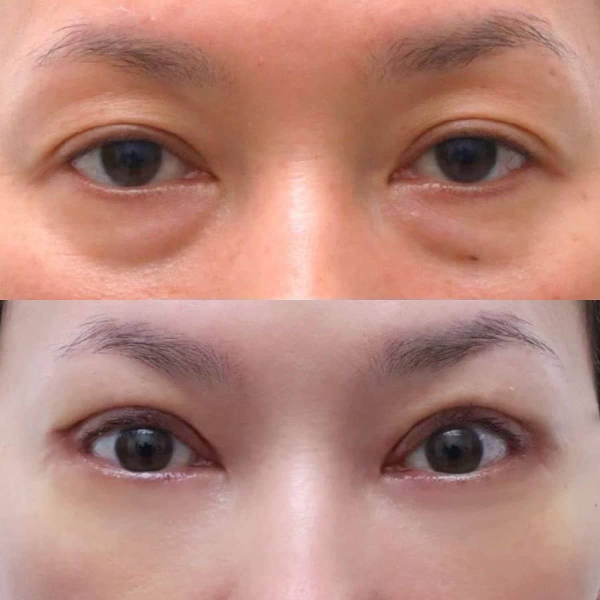 Case 12487 - lower eyelid blepharoplasty