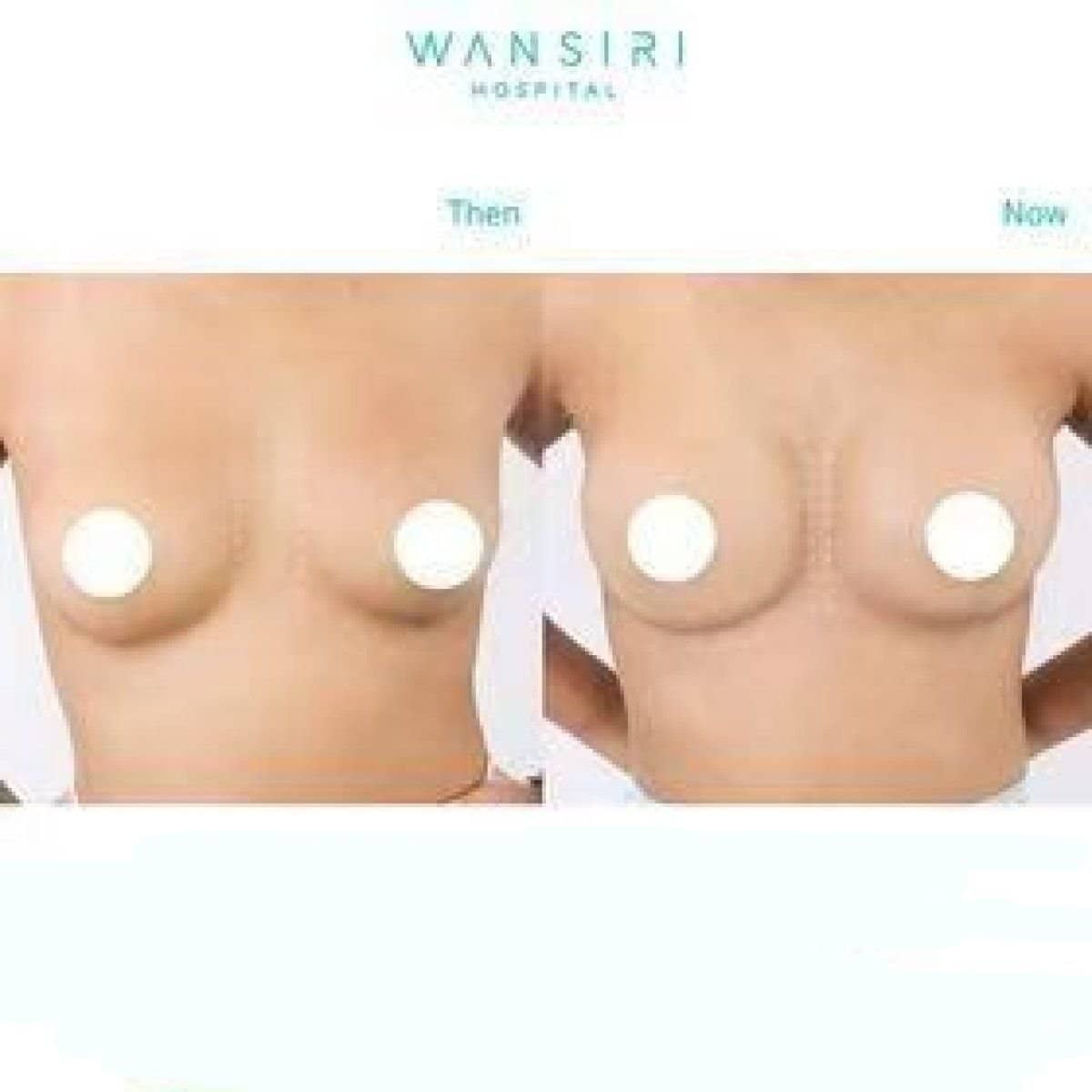 Case 12488 - breast augmentation