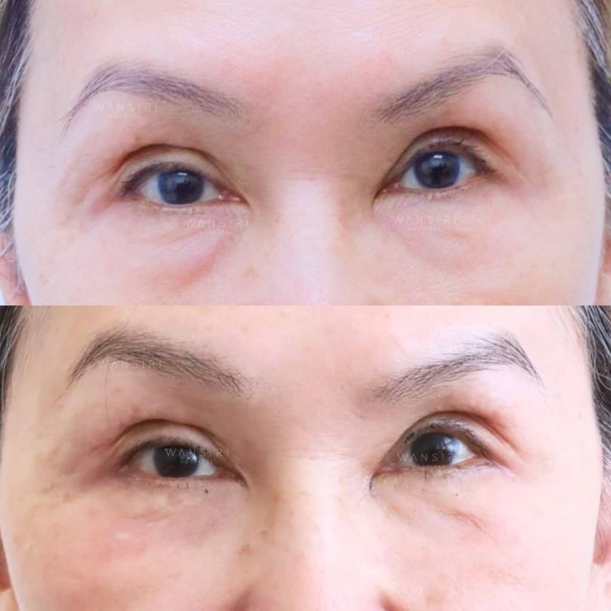 Case 12489 - lower eyelid blepharoplasty