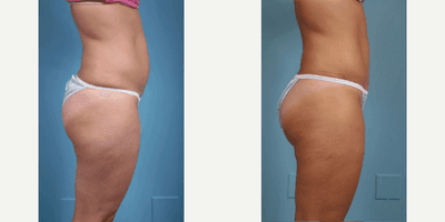 Case 1249 - Woman treated with Tummy Tuck