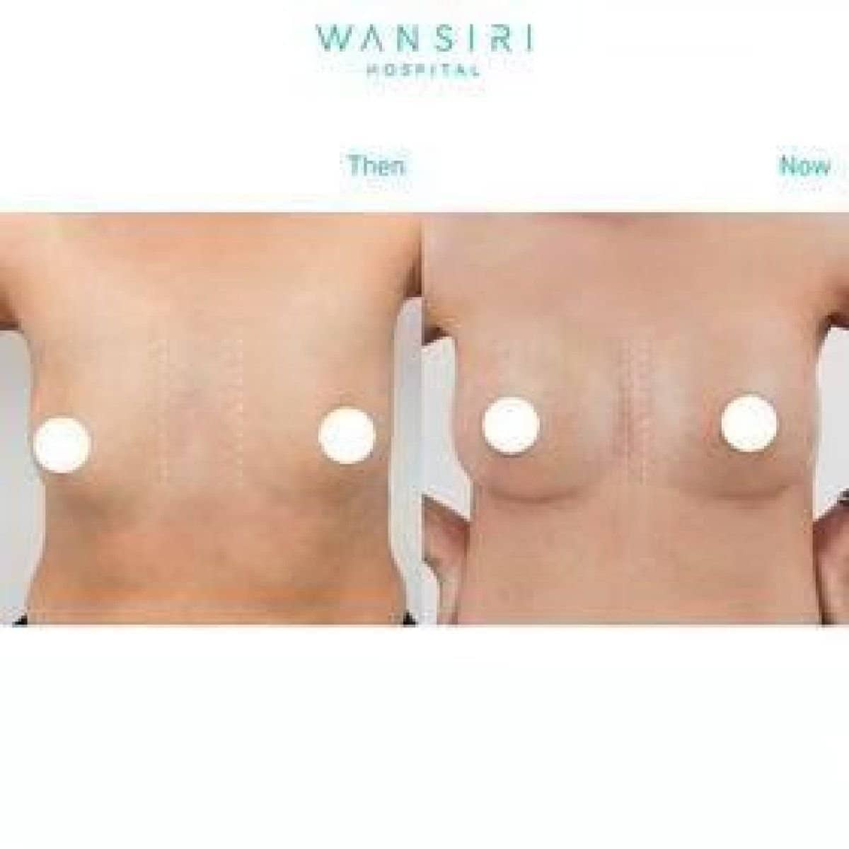 Case 12491 - breast augmentation