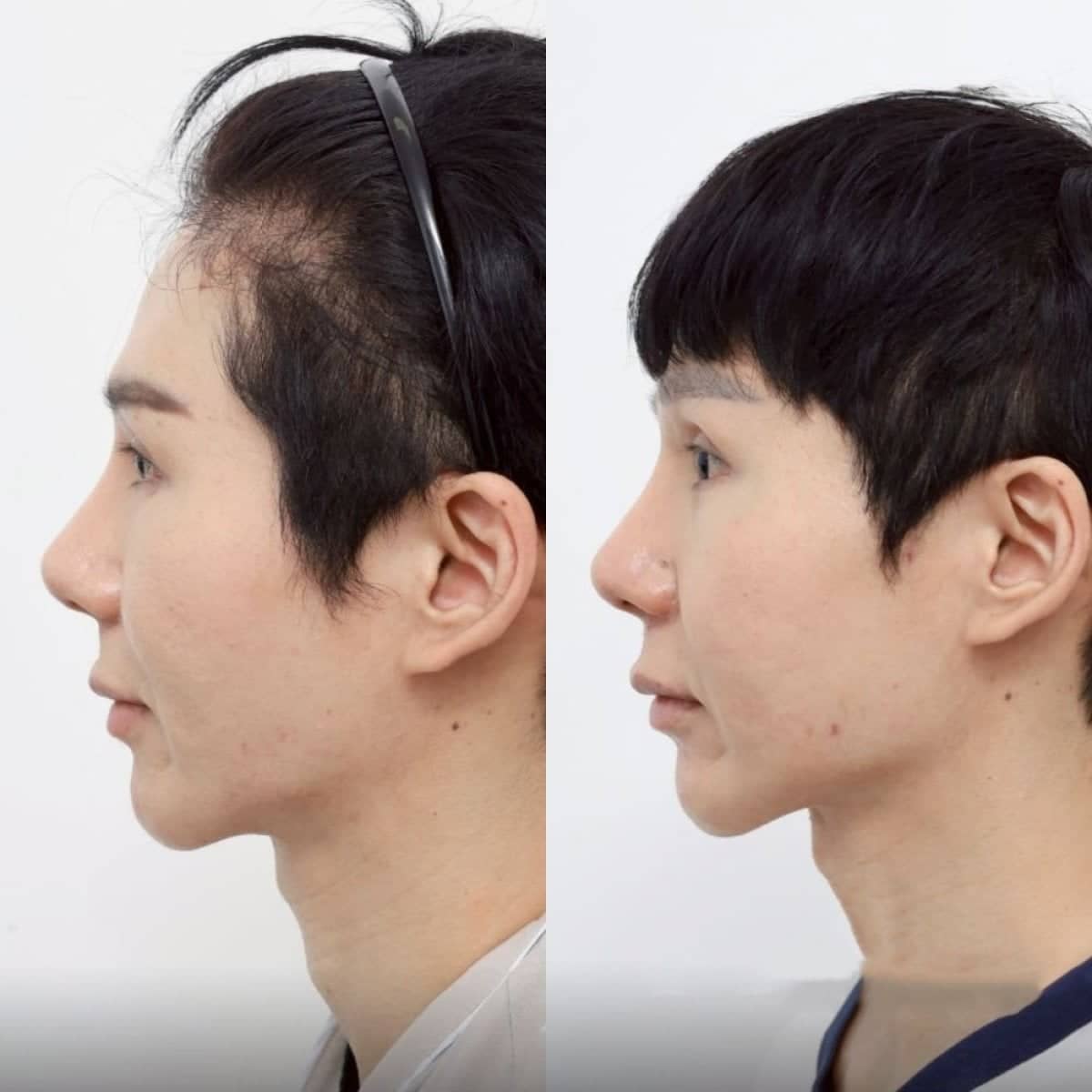 Case 12498 - cheekbone reduction