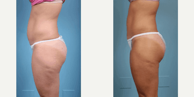 Case 1250 - Woman treated with Tummy Tuck