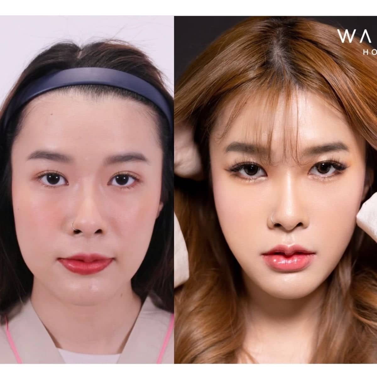 Case 12505 - cheekbone reduction