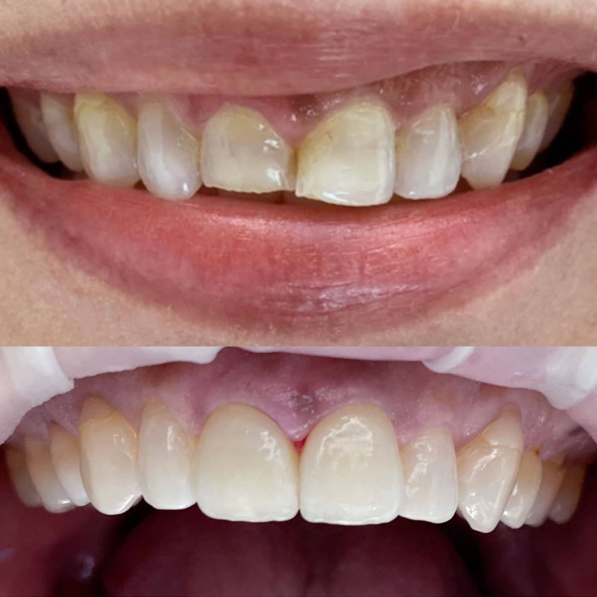 Case 12506 - porcelain veneer