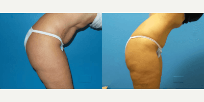 Case 1251 - Woman treated with Tummy Tuck