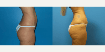 Case 1252 - Woman treated with Tummy Tuck