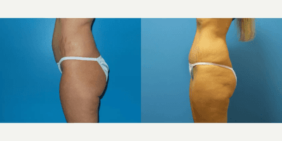Case 1253 - Woman treated with Tummy Tuck
