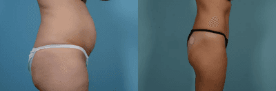 Case 1254 - Woman treated with Tummy Tuck