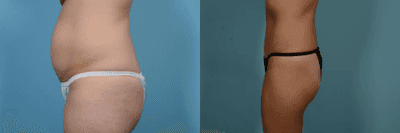 Case 1255 - Woman treated with Tummy Tuck