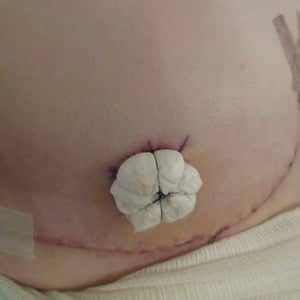 Case 12622 - Masculinizing Top Surgery