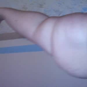 Case 12635 - Panniculectomy
