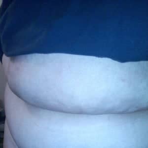 Case 12636 - Panniculectomy