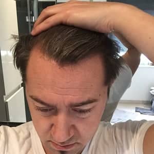 Case 12732 - Hair Transplant