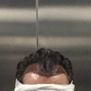 Case 12734 - Hair Transplant