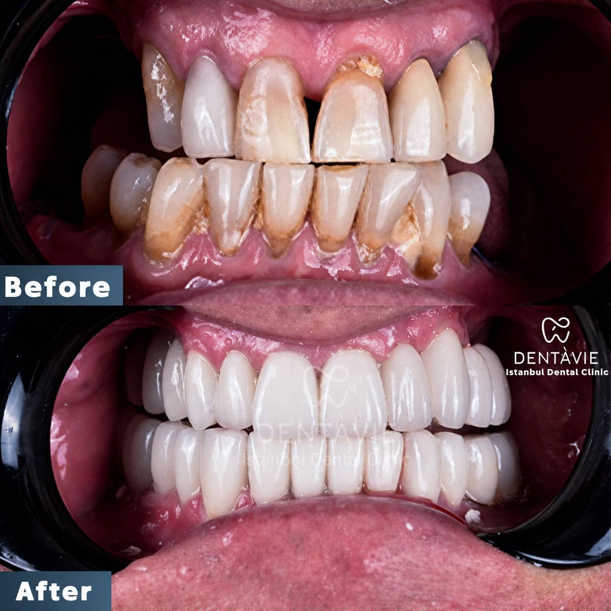 Case 13149 - All-on-4 dental implants