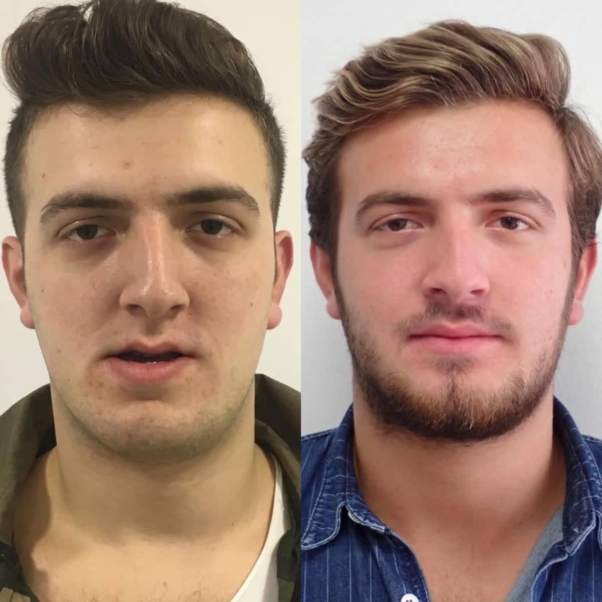 Case 13155 - orthognathic surgery