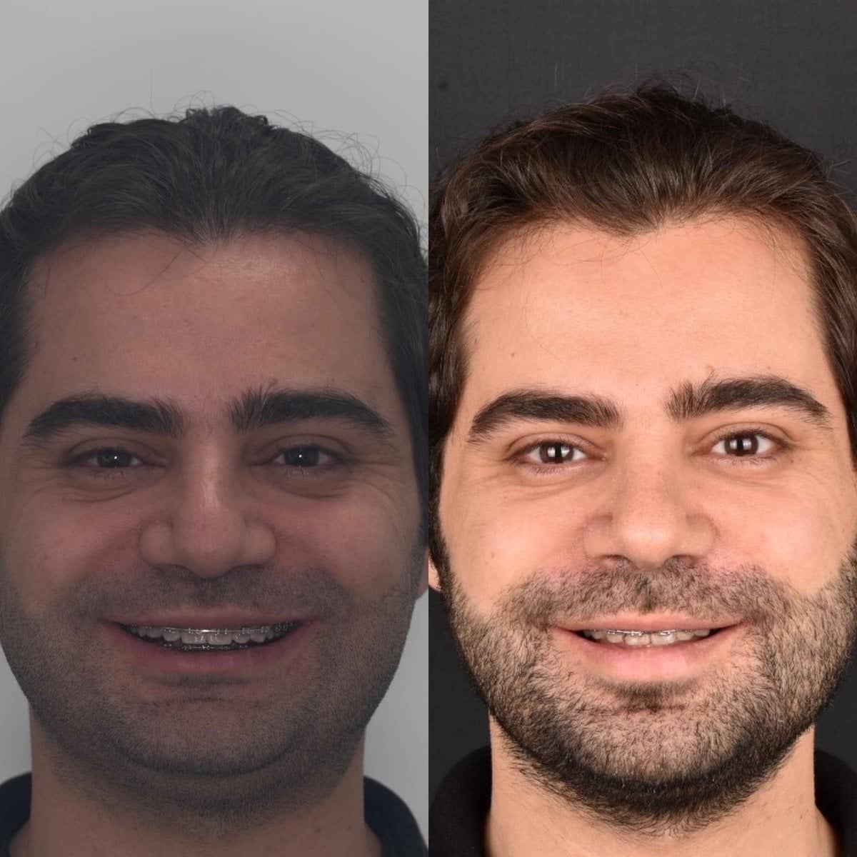 Case 13156 - orthognathic surgery