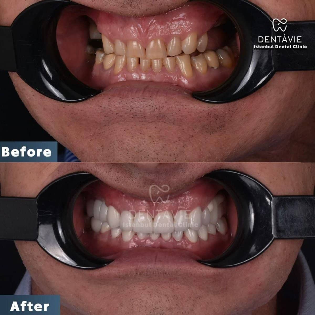 Case 13161 - Hollywood Smile