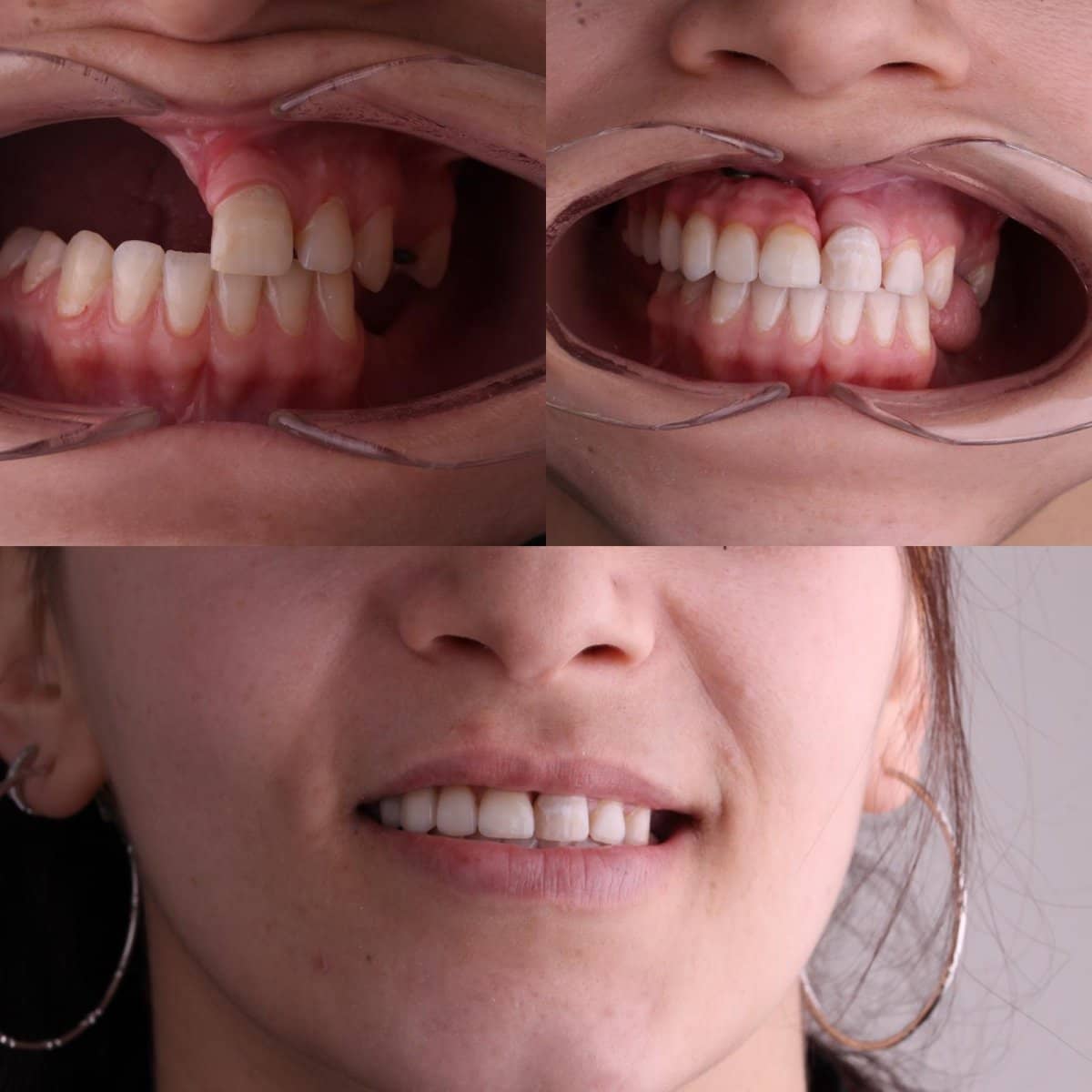 Case 13170 - jaw implant