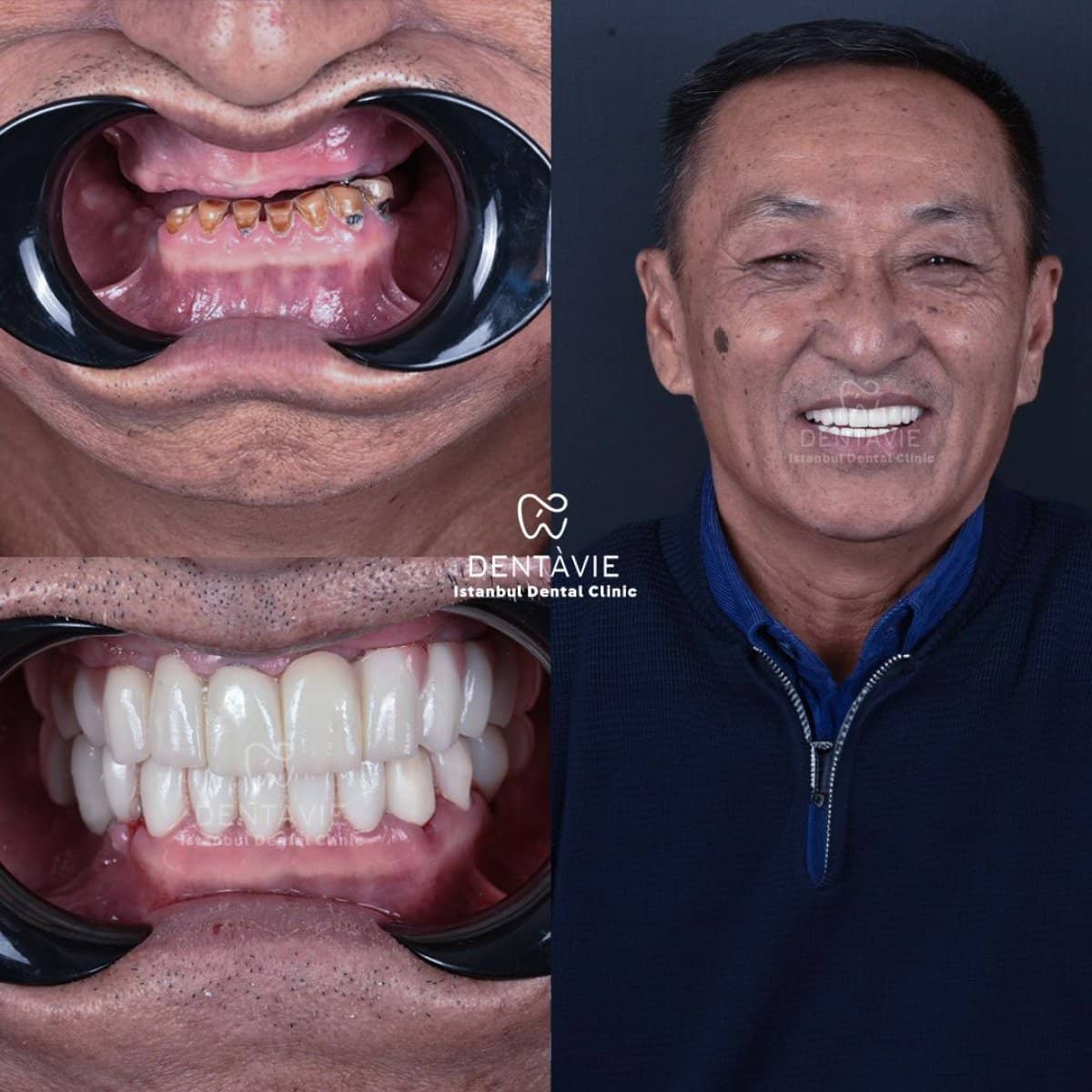 Case 13173 - All-on-6 dental implants