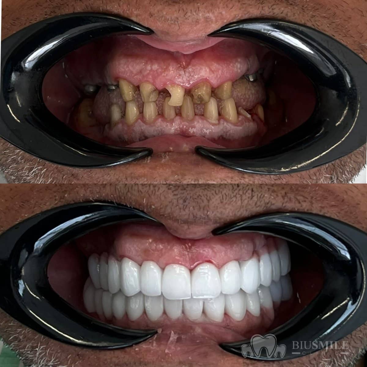 Case 13179 - zirconia crown installation