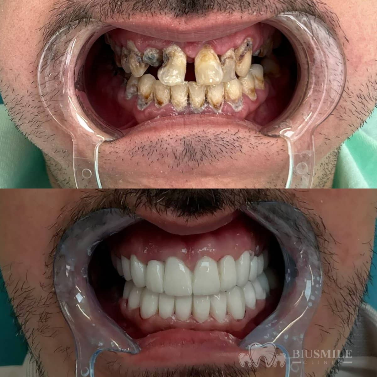 Case 13180 - zirconia crown installation