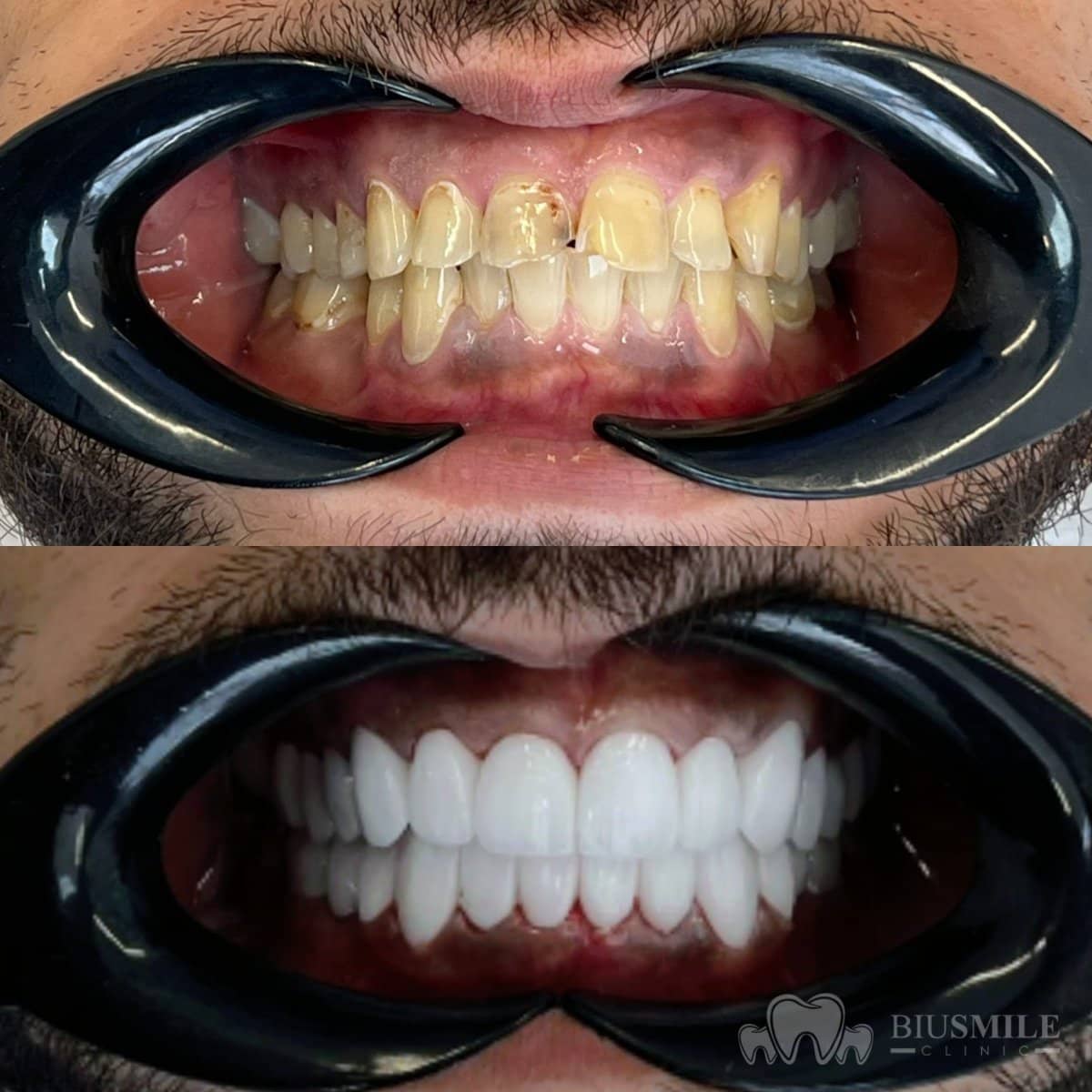 Case 13186 - zirconia crown installation