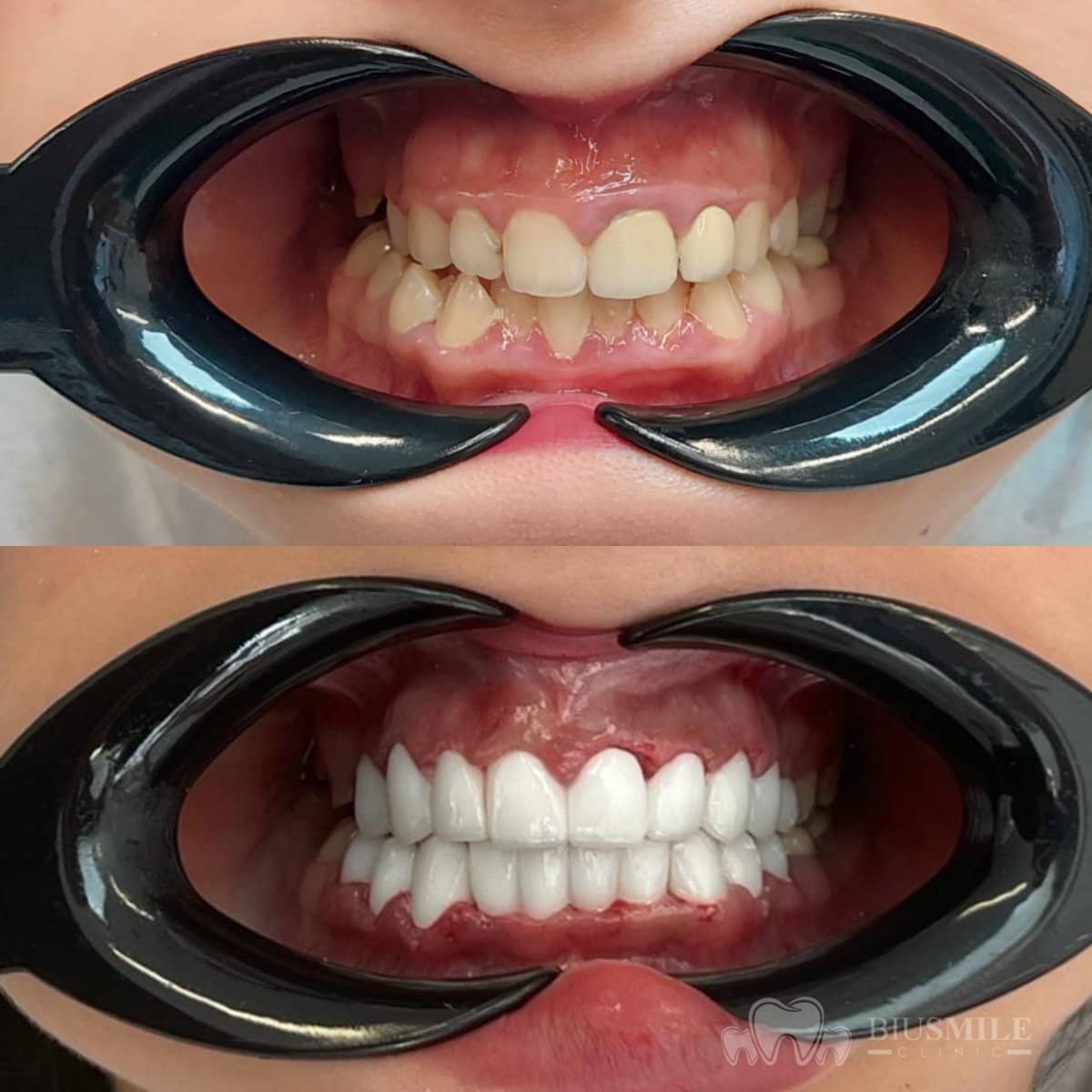 Case 13187 - zirconia crown installation