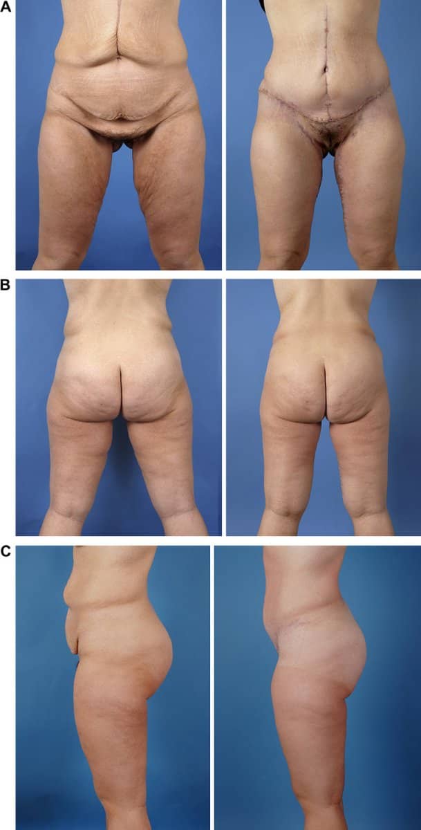 Case 13205 - thigh lift
