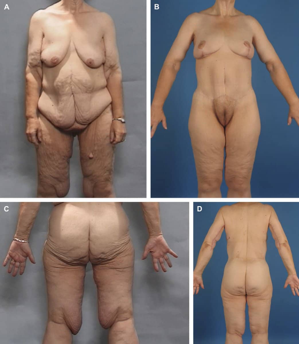 Case 13206 - thigh lift