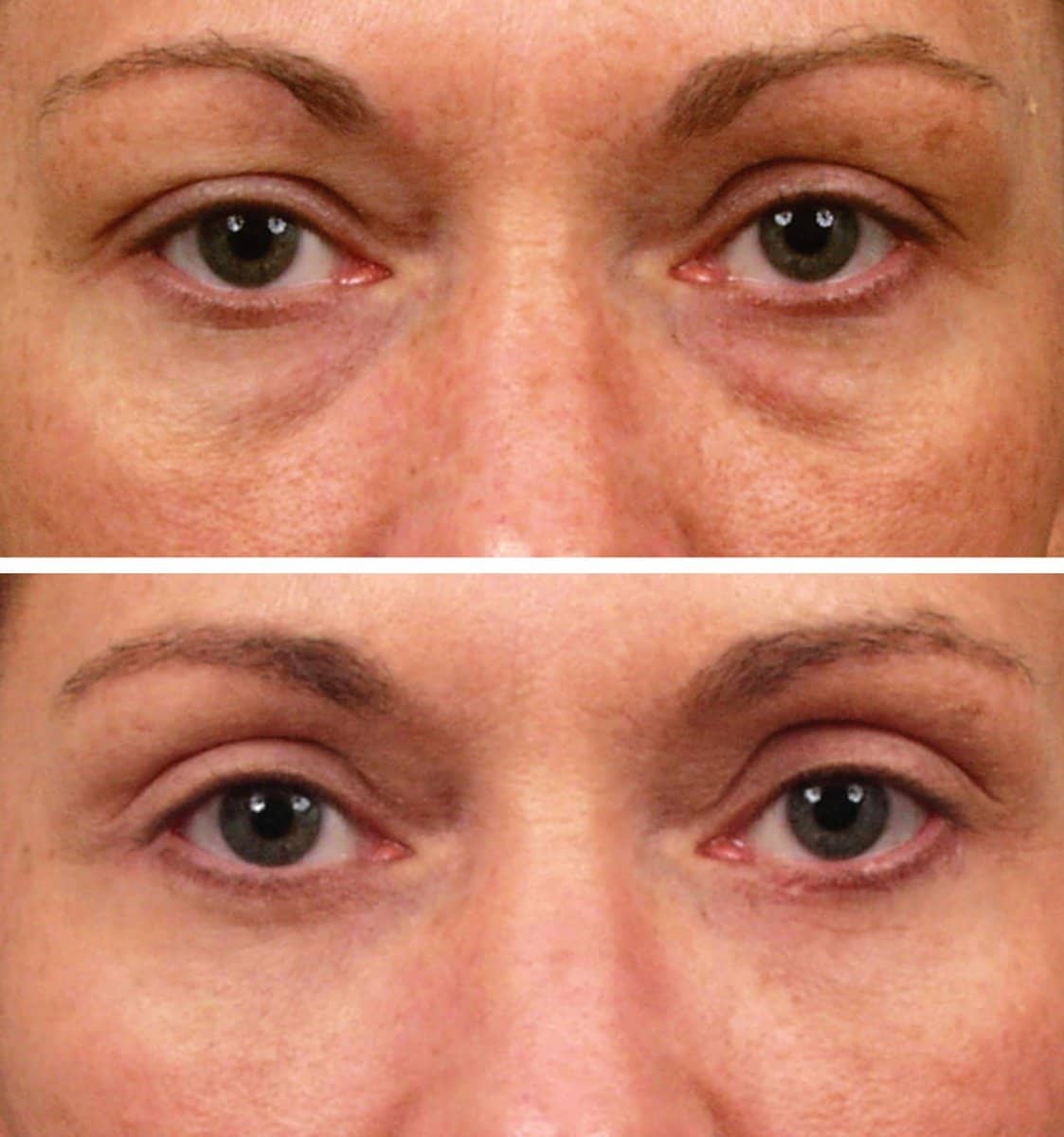 Case 13207 - blepharoplasty