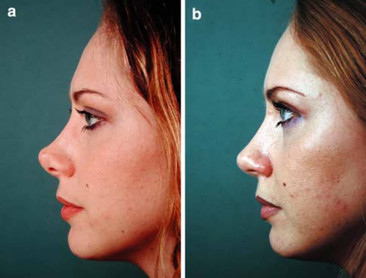 Case 13208 - closed rhinoplasty