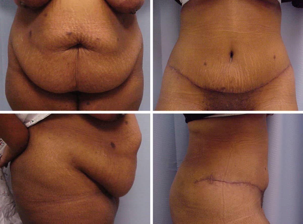 Case 13209 - tummy tuck