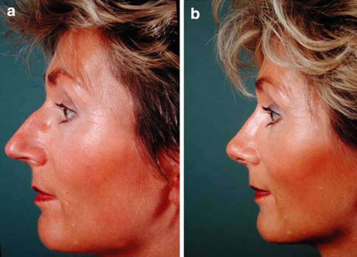 Case 13211 - rhinoplasty