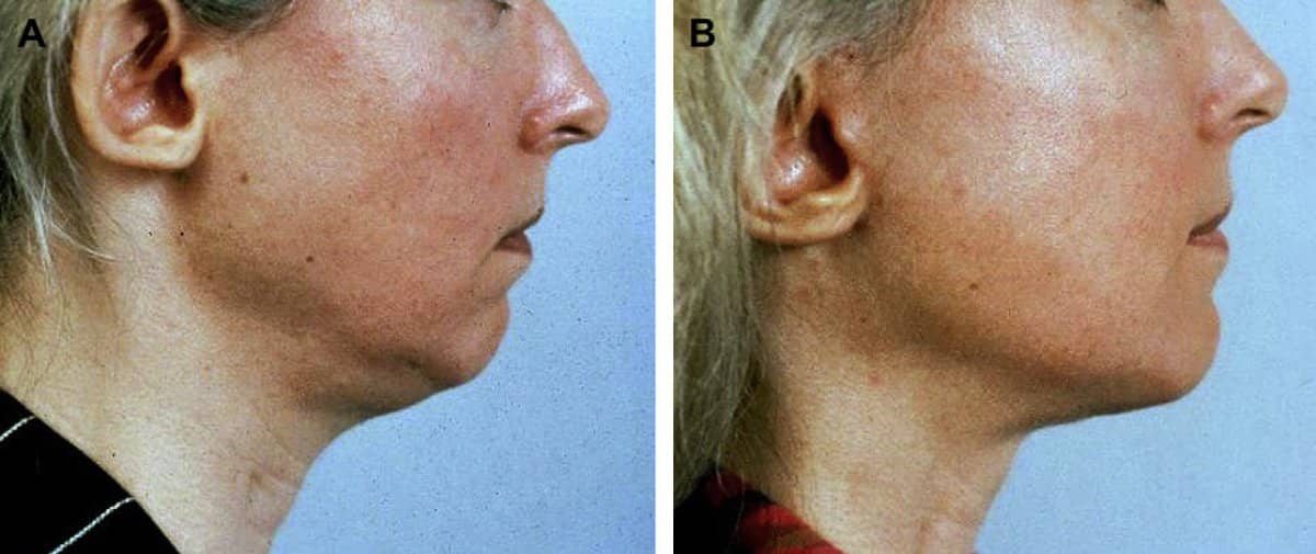 Case 13213 - neck lift
