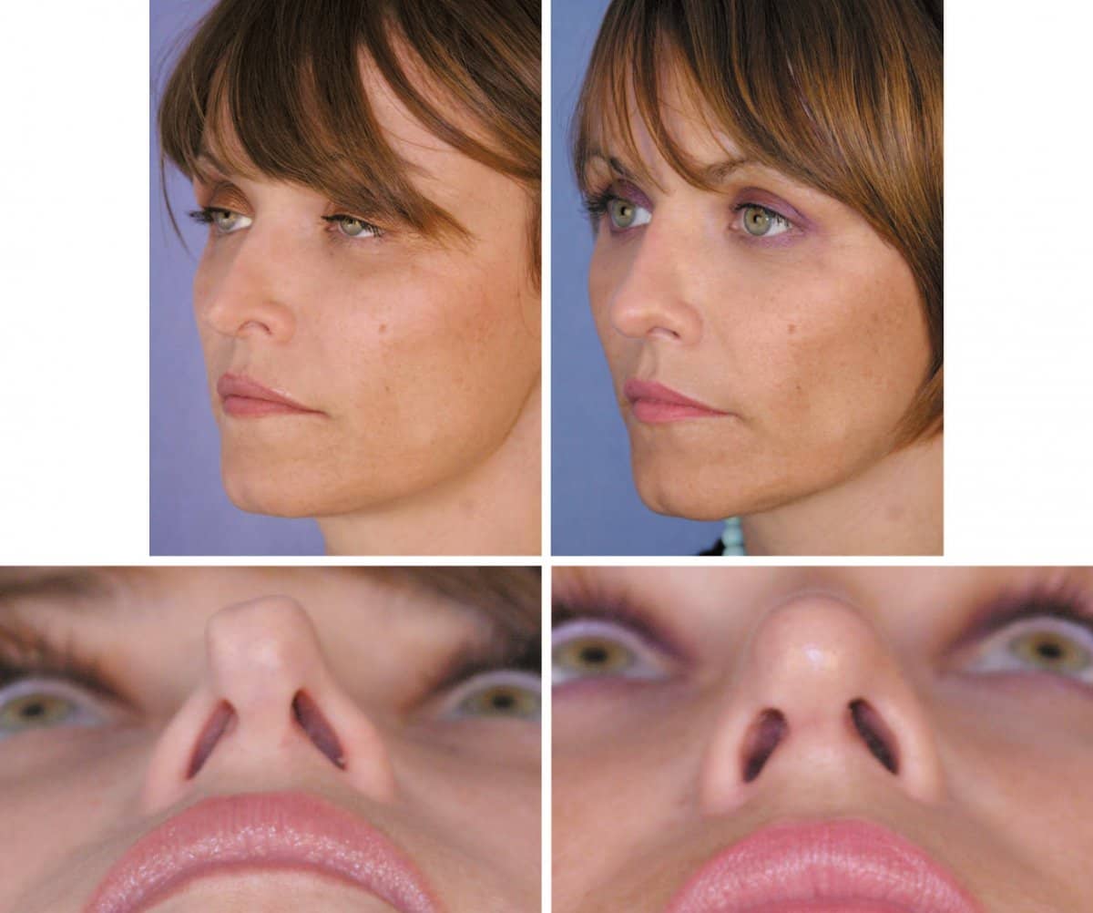 Case 13216 - rhinoplasty