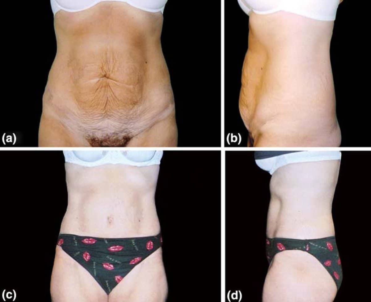 Case 13217 - liposuction